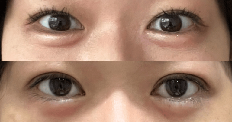 埋没法二重術の施術前と術後7日目の比較写真