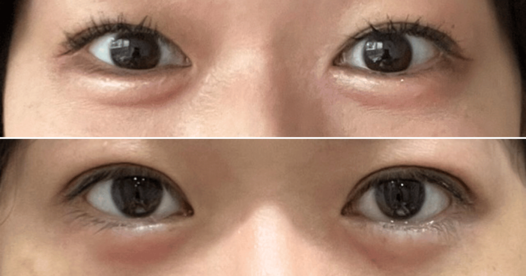 水の森美容クリニック二重埋没法のダウンタイム7日目の様子。上段が施術前、下段が施術1週間後のビフォーアフター写真