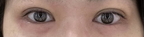 水の森美容クリニックで二重埋没法を行った直後（施術当日）に撮影した、まぶたが腫れている様子