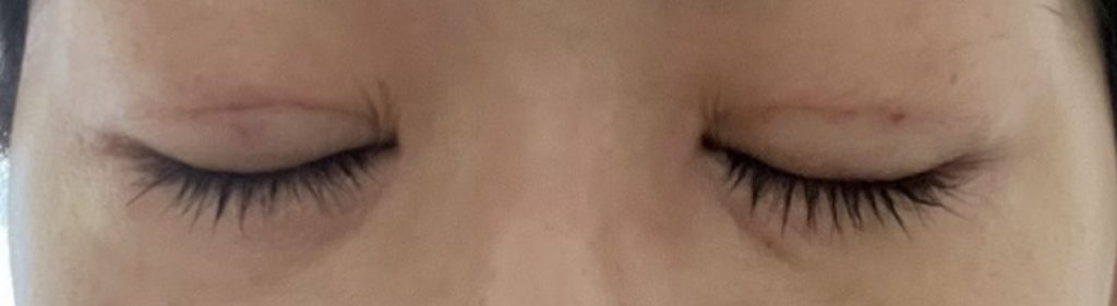 埋没法の手術から1日目の、目を閉じて撮影した経過写真。傷跡は赤みが少し引くが、右目まぶたにある内出血が目立つように。