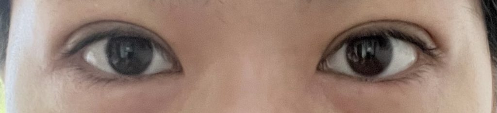 埋没法の手術から1日目の、正面を向いて撮影した経過写真。まぶたが腫れている様子。この時が腫れのピーク。