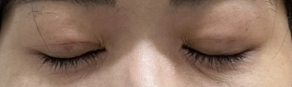 埋没法の手術から2日目の下を向いて撮影した経過正面。右目のまぶたにある、内出血の赤みが目立つ。傷跡は赤みが引いて目立ちにくくなる。