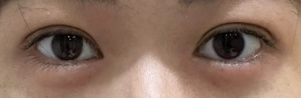 埋没法の手術から2日目の正面から撮影した経過正面。腫れは昨日よりも引いて、思ったほど目立たない。