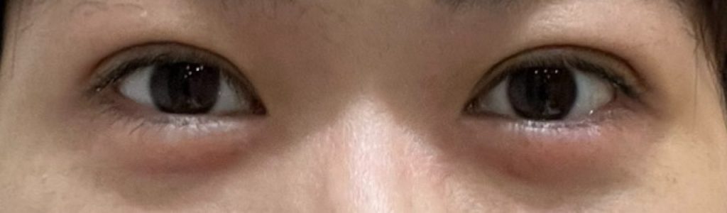 埋没法の手術から2日目の笑顔で撮影した経過正面。まぶたの腫れは思ったほど目立たないが、笑うと腫れが少し目立つ。