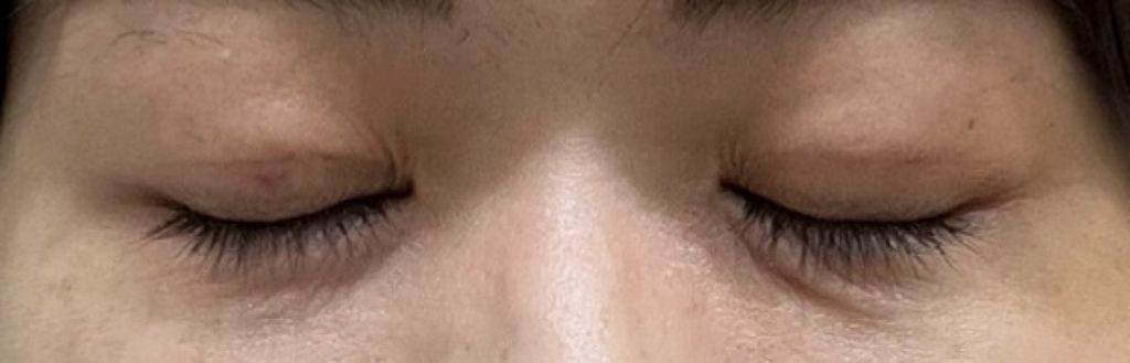 埋没法の手術から3日目の目を閉じて撮影した経過正面。昨日に比べて、右目まぶたにある内出血の赤みは少し引く。