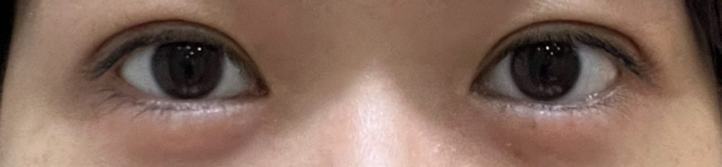 埋没法の手術から3日目の正面から撮影した経過正面。昨日泣いたのかなと思うくらいの、まぶたの腫れ。埋没したとは気づかれない程度。