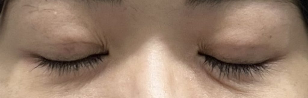 埋没法の手術から4日目の目を閉じて撮影した経過正面。内出血の赤みは引いて少し茶色に。目を閉じるなどしないと目立たない程度。