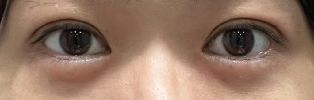 埋没法の手術から4日目の正面から撮影した経過正面。昨日よりもまぶたの腫れも引き、整形感のない自然な二重幅に。ほぼダウンタイムは終了。