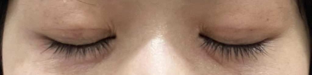 埋没法の手術から5日目の目を閉じて撮影した経過正面。昨日と大きな変化はないが、気持ち内出血の箇所が目立たなくなった。