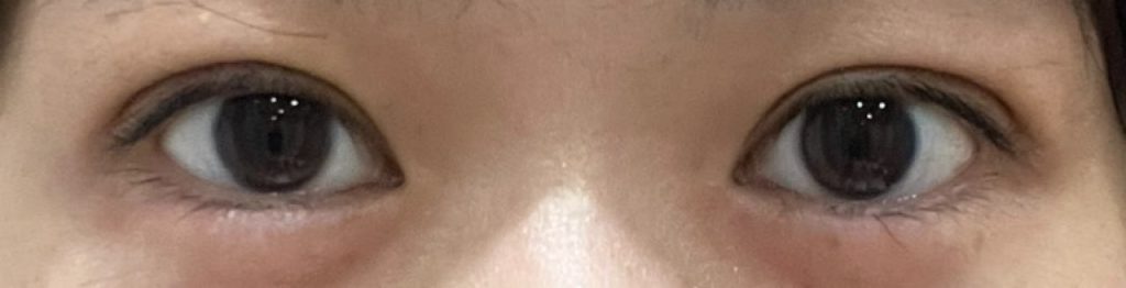 埋没法の手術から5日目の正面から撮影した経過正面。腫れがまた引いて、二重幅か昨日に比べて少し狭くなる。より自然な二重に。