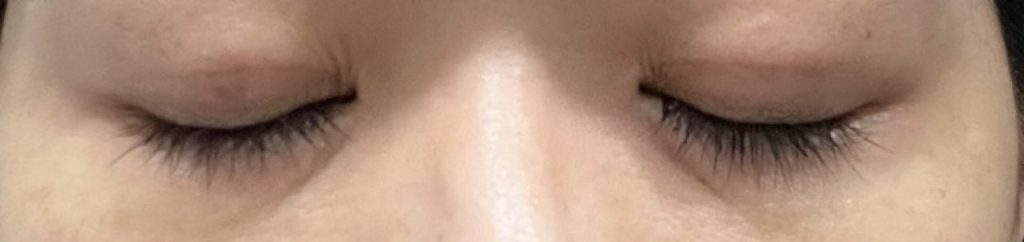 埋没法の手術から6日目の目を閉じて撮影した経過正面。内出血の赤みが更に引き、徐々にと目立ちにくくなってきた。