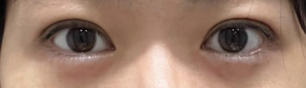 埋没法の手術から6日目の正面から撮影した経過正面。昨日と比べて、腫れや二重幅の大きな変化はなし。