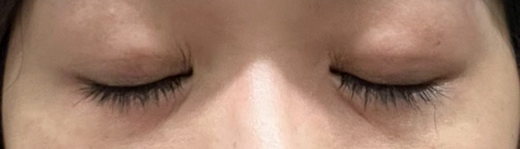 埋没法の手術から7日目の目を閉じて撮影した経過正面。内出血はほぼ目立たなくなり、コンシーラーで隠す必要がないほど。