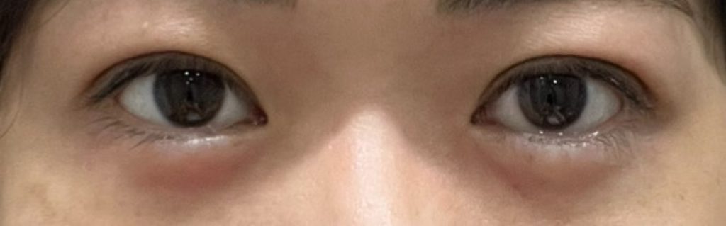 埋没法の手術から7日目の正面から撮影した経過正面。術後5・6日目に比べて二重幅が若干狭くなった目の様子。二重はほぼ完成形に。