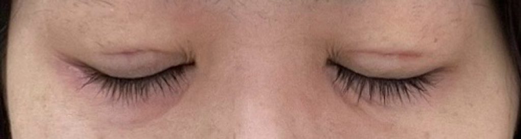 水の森美容クリニックで二重埋没をした直後に撮影した、目を閉じたときの目元。この時から、まぶたに糸玉はなし。