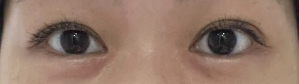 水の森美容クリニックで二重埋没後、1ヶ月が経過した目元。薄いメイクで目を開けた状態で撮影。腫れは引き、自然な二重に。