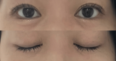 水の森美容クリニック埋没法3ヶ月経過レポ｜左右差や糸玉のポコつきは？｜28歳CAの体験記④