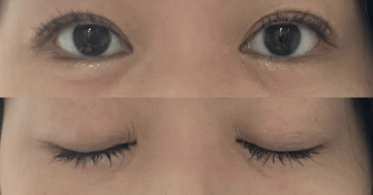 水の森美容クリニックの埋没法（二重整形）から3ヶ月後の経過写真。開眼と閉眼時の上下比較写真。