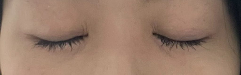 水の森美容クリニックで二重埋没後、3ヶ月が経過した目元。目を閉じても糸の結び目はなく、埋没したとは気づかないほどの仕上がり。