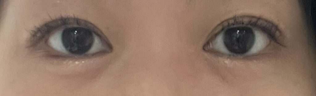 水の森美容クリニックで二重埋没後、3ヶ月が経過した目元。左右の目の開きに差があるため二重幅も左右差が若干あるが、目立つことはなく自然な仕上がり。