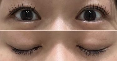 水の森美容クリニック横浜院の二重埋没から8ヶ月。二重の持ちと幅の経過を本音レビュー｜28歳CAの体験記⑤