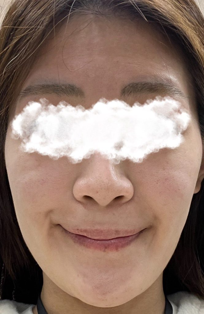 ピコトーニング施術直後の何も塗っていない肌の様子。赤みは思ったよりも少ないが、肌が乾燥してカラカラ。少しくすみが減って肌が明るくなった気がする。