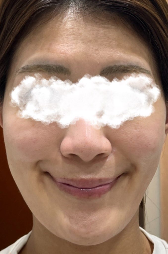 ピコトーニング施術8時間後の肌。一番効果を感じた時間帯で、肌が少しトーンアップしてる様子。気になっていた口周りのくすみが、以前よりも目立たなくなる。
