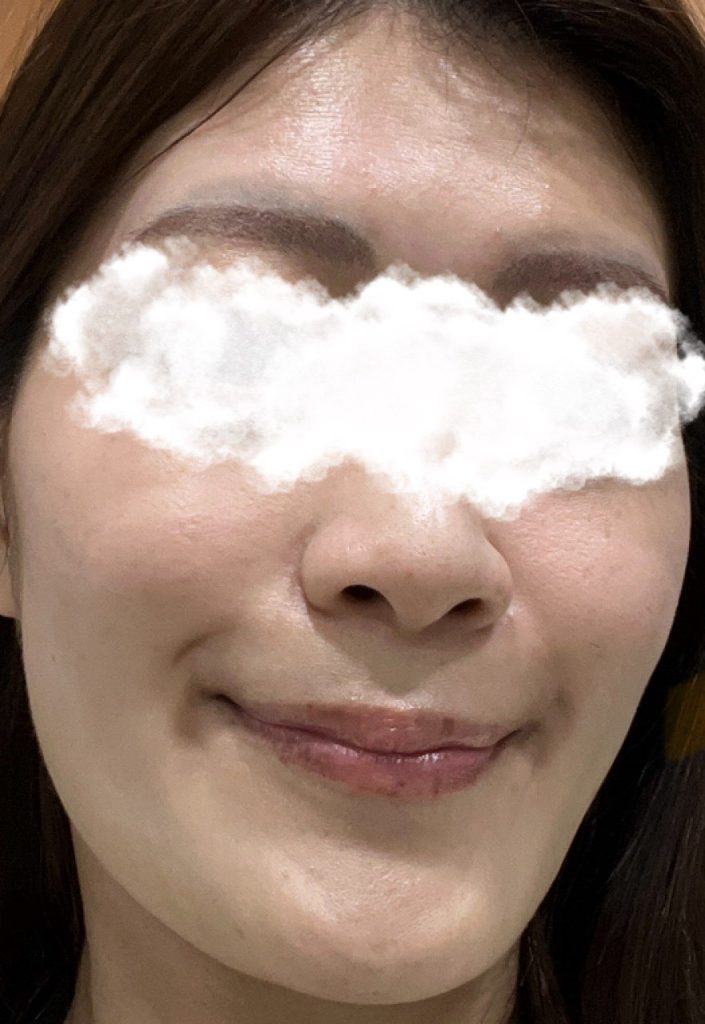 ピコトーニング翌日の肌。日焼け止め・下地のみ。いつも通りのメイクで、おでこから顎まで、ライトに当たっている場所がツヤツヤと発光している。ハイライトもファンデも不要なほど。