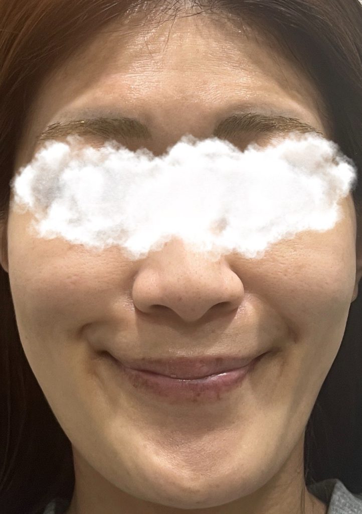 ピコトーニング施術7日目の肌の様子。肌全体のトーンが上がり、手触りも柔らかくなった。しっかりめにケアしたからか、大きなトラブルもなく肌の経過は順調。全体的に肌にツヤが出て、口周りのくすみが以前よりも気にならないほど。