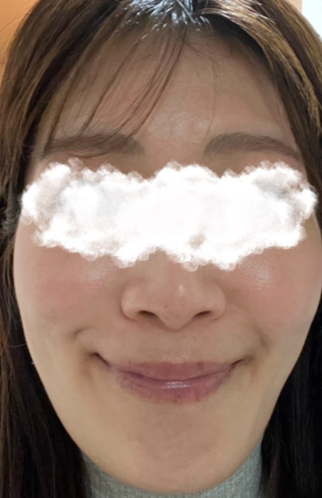 ピコトーニング施術7日目の肌の様子。頬がツヤツヤと光っている様子。日焼け止めと下地のみで、ハイライト・ファンデなし。

