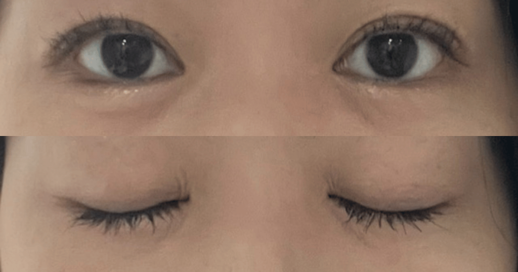 水の森美容クリニック横浜院で二重埋没法をして３ヶ月が経過した目元。開眼・閉眼の上下比較画像。