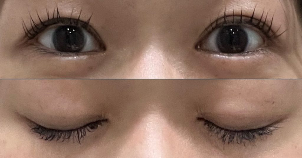 水の森美容クリニック横浜院で二重埋没法を受けて、8ヶ月が経過した目元。まつ育の効果もあり、目力がアップしている様子。