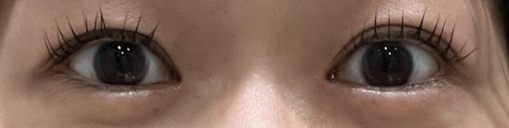 埋没法を受けて8ヶ月が経過した目元。コンプレックスが解消されて、パッチリとした目元に。