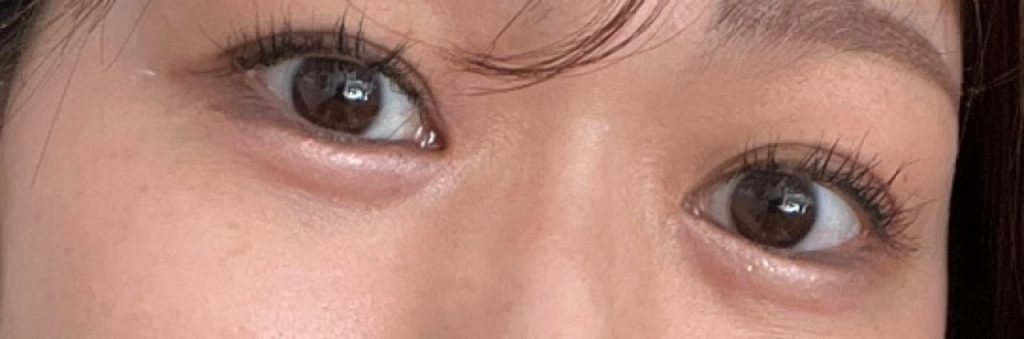 埋没をして8ヶ月が経過した目元。涙袋ヒアルロン酸との相性も良く、目元がより丸く、可愛らしい印象に。