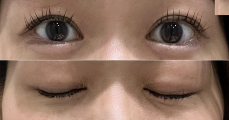 水の森美容クリニックでの二重埋没法から8ヶ月経過した28歳CAの目元写真。自然な仕上がりとまつ毛の美しさを強調したビフォーアフター。
