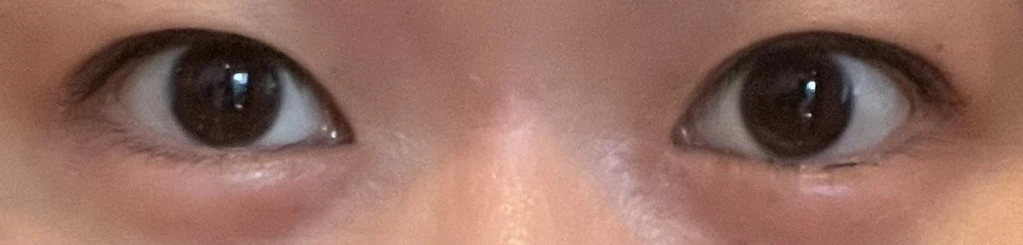 二重埋没をする前の、腫れぼったいまぶたがコンプレックスだった、奥二重の目元。