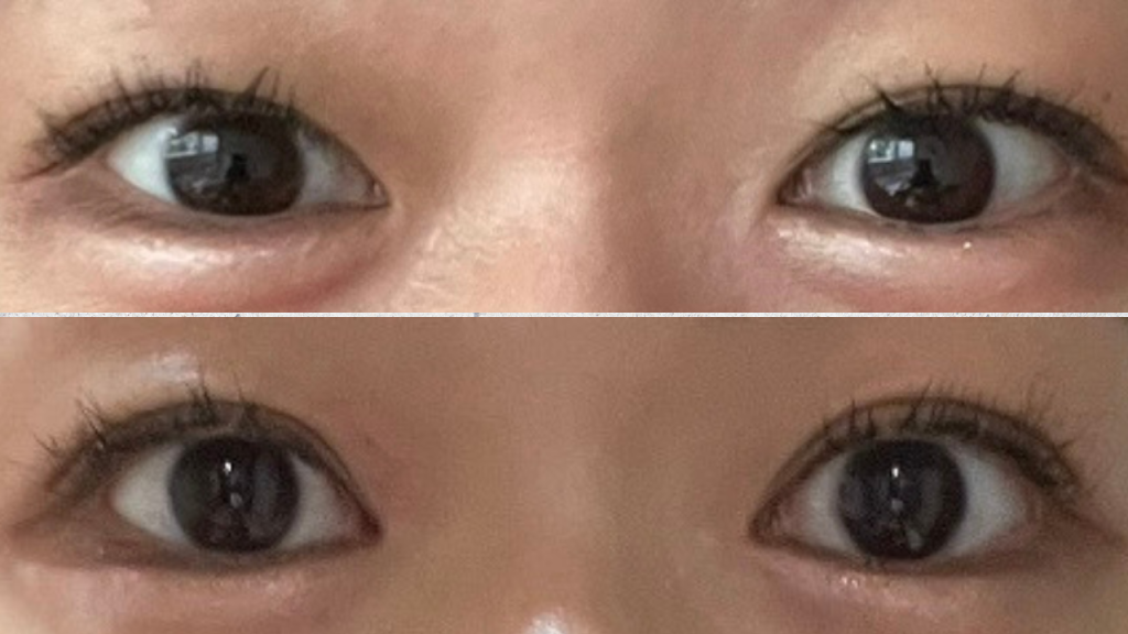 埋没前の目元と水の森美容クリニック横浜院で二重埋没法を行ったあとの、二重になった目元の上下比較写真。