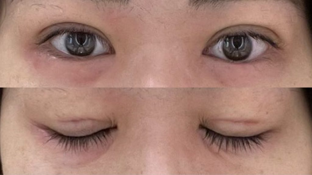 水の森美容クリニック横浜院での二重埋没直後の目元。開眼・閉眼の目元が上下に表示されている様子。